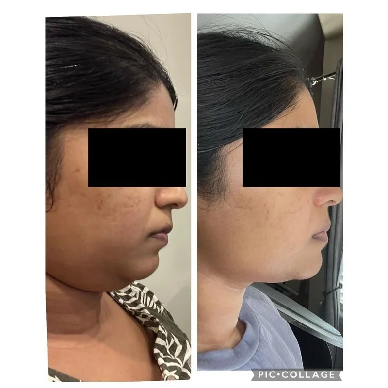 Face yoga client transformation 9